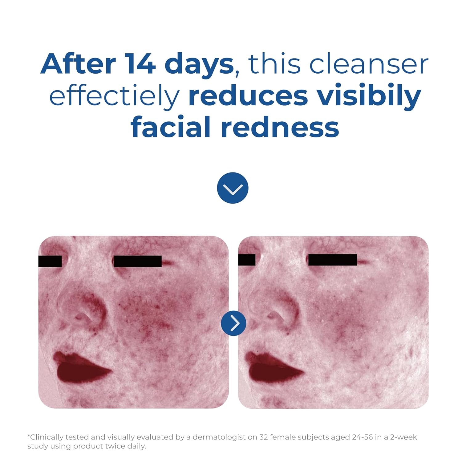 image:imageEltaMD Skin Recovery Amino Acid Foaming Face Wash FragranceFree Gentle Cleanser For Sensitive Skin Removes Makeup And Sunscreen Reduces Facial Redness Noncomedogenic5 Fl Oz Pack of 1
