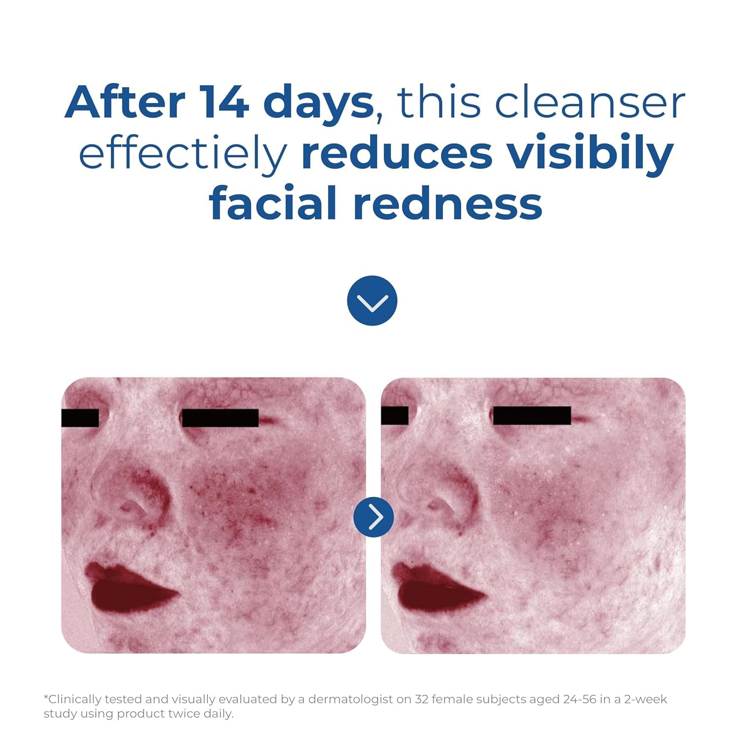 image:imageEltaMD Skin Recovery Amino Acid Foaming Face Wash FragranceFree Gentle Cleanser For Sensitive Skin Removes Makeup And Sunscreen Reduces Facial Redness Noncomedogenic1 Fl Oz Pack of 1