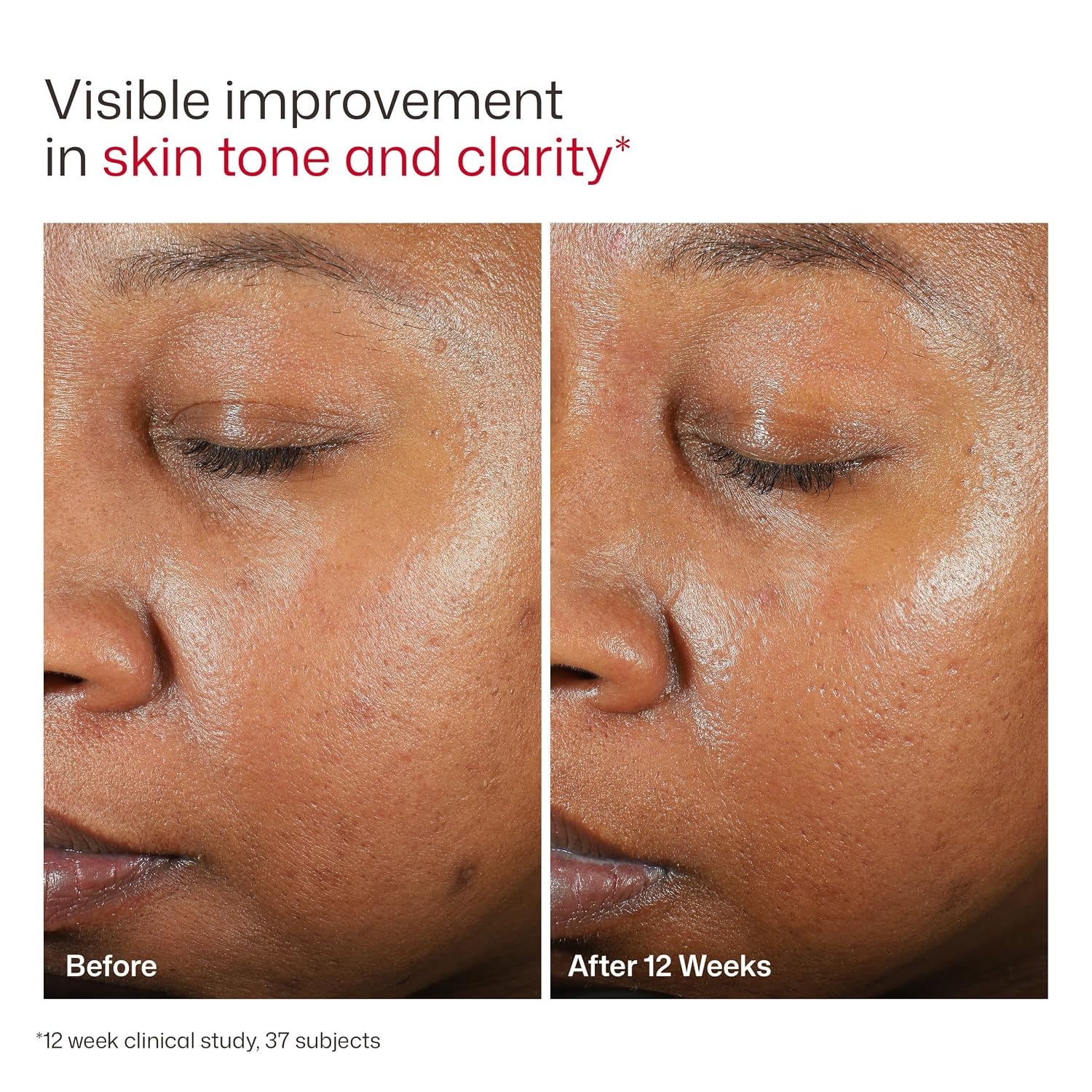 image:imageEltaMD UV Clear Face Sunscreen with Zinc Oxide OilFree SPF 46 and SPF 50 Calms and Protects AcneProne Skin and Rosacea No White Cast Dermatologist Recommended Available in Three Tints and Sizes06 Untinted 37 oz