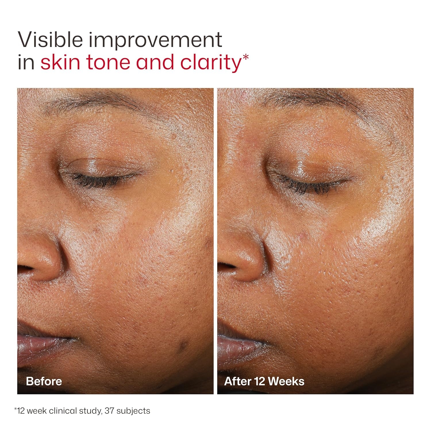 image:imageEltaMD UV Clear Face Sunscreen with Zinc Oxide OilFree SPF 46 and SPF 50 Calms and Protects AcneProne Skin and Rosacea No White Cast Dermatologist Recommended Available in Three Tints and Sizes10 Untinted 05 oz