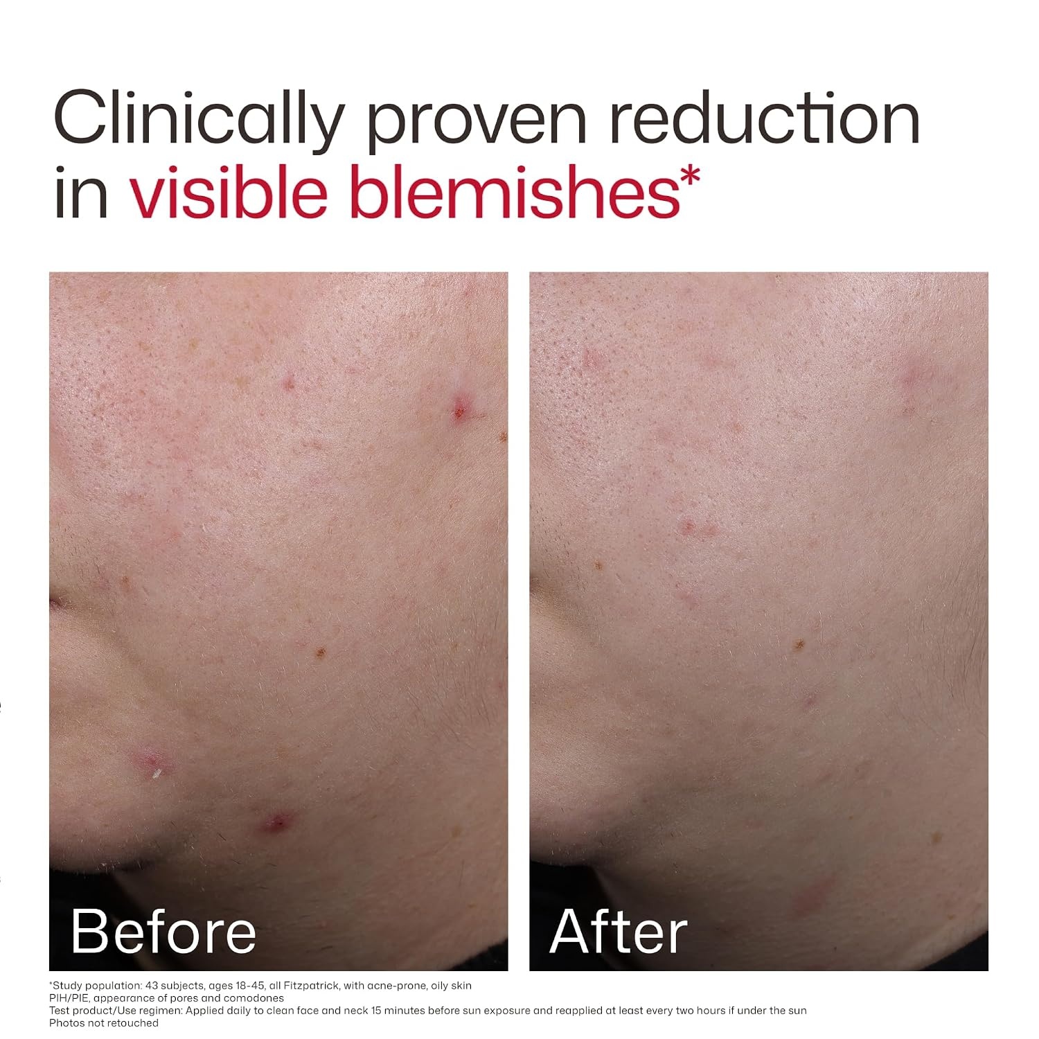 image:imageEltaMD UV Clear Face Sunscreen with Zinc Oxide OilFree SPF 46 and SPF 50 Calms and Protects AcneProne Skin and Rosacea No White Cast Dermatologist Recommended Available in Three Tints and Sizes01 New Blemish Prone 17 oz