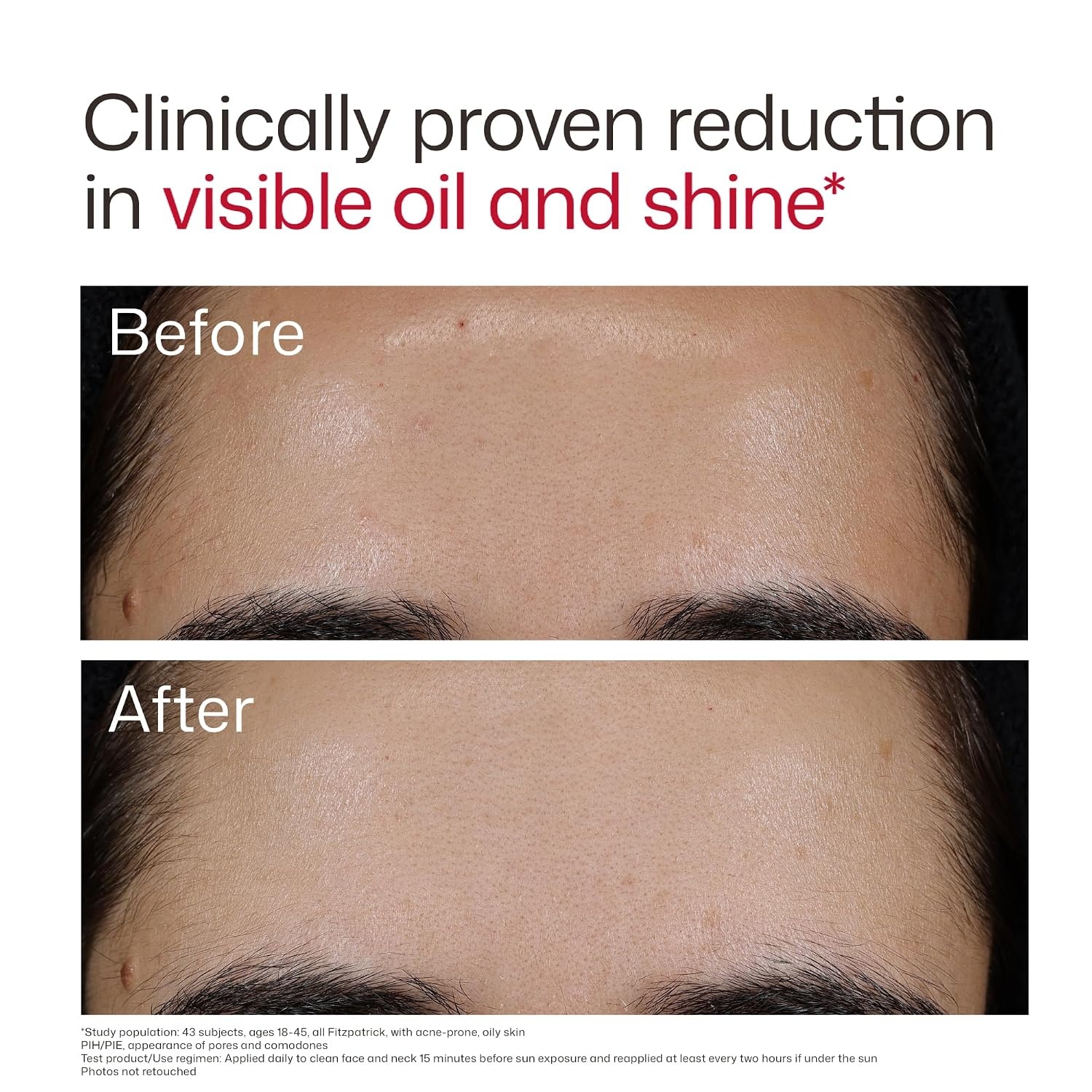 image:imageEltaMD UV Clear Face Sunscreen with Zinc Oxide OilFree SPF 46 and SPF 50 Calms and Protects AcneProne Skin and Rosacea No White Cast Dermatologist Recommended Available in Three Tints and Sizes01 New Blemish Prone 17 oz