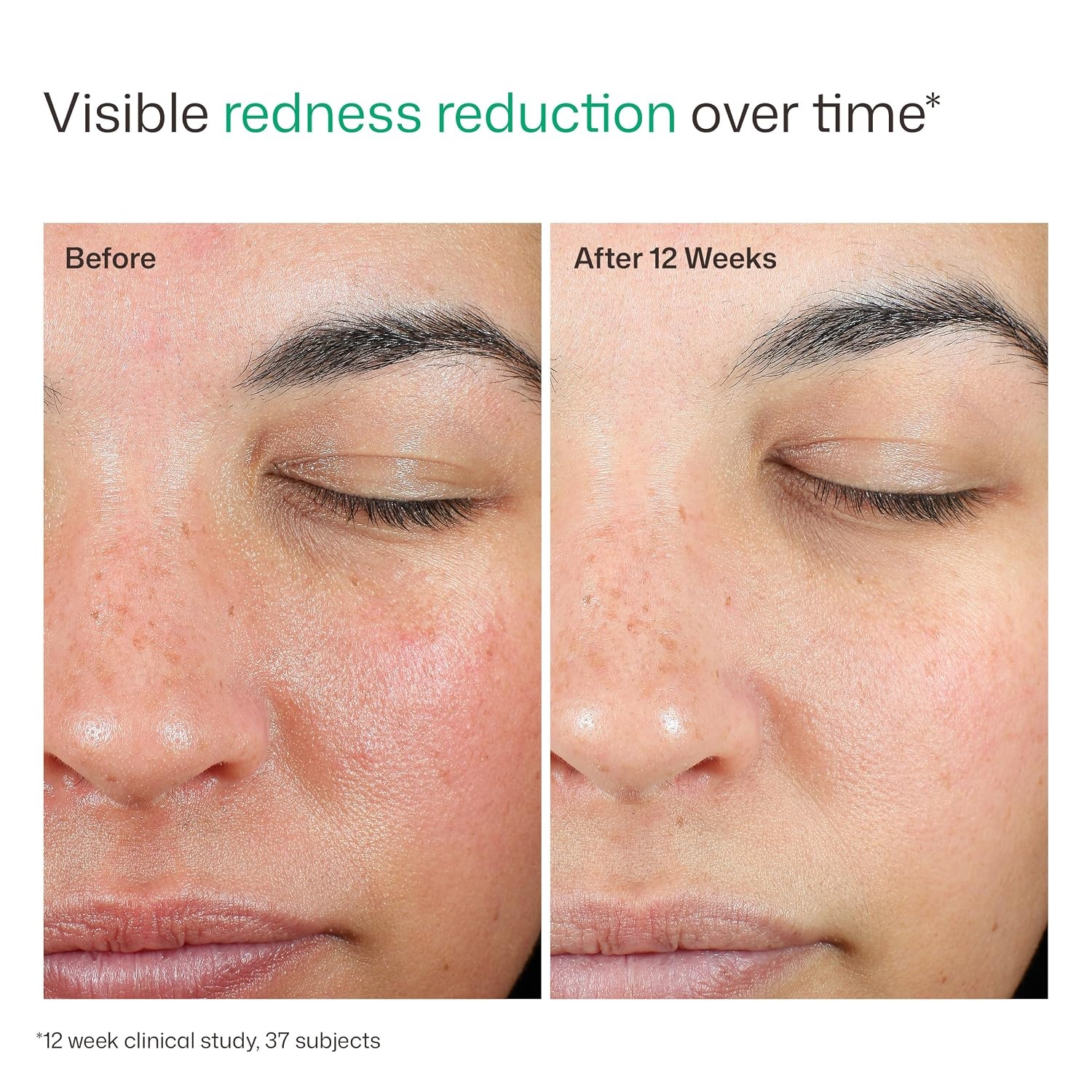 image:imageEltaMD UV Skin Recovery 100 Mineral Face Sunscreen SPF 50 Red Color Correcting Safe For Rosacea and PostProcedure Skin No White Cast Zinc Oxide Dermatologist RecommendedUntinted 17 oz